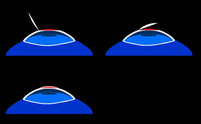 Diagram of an Implantable Contact Lens (ICL)